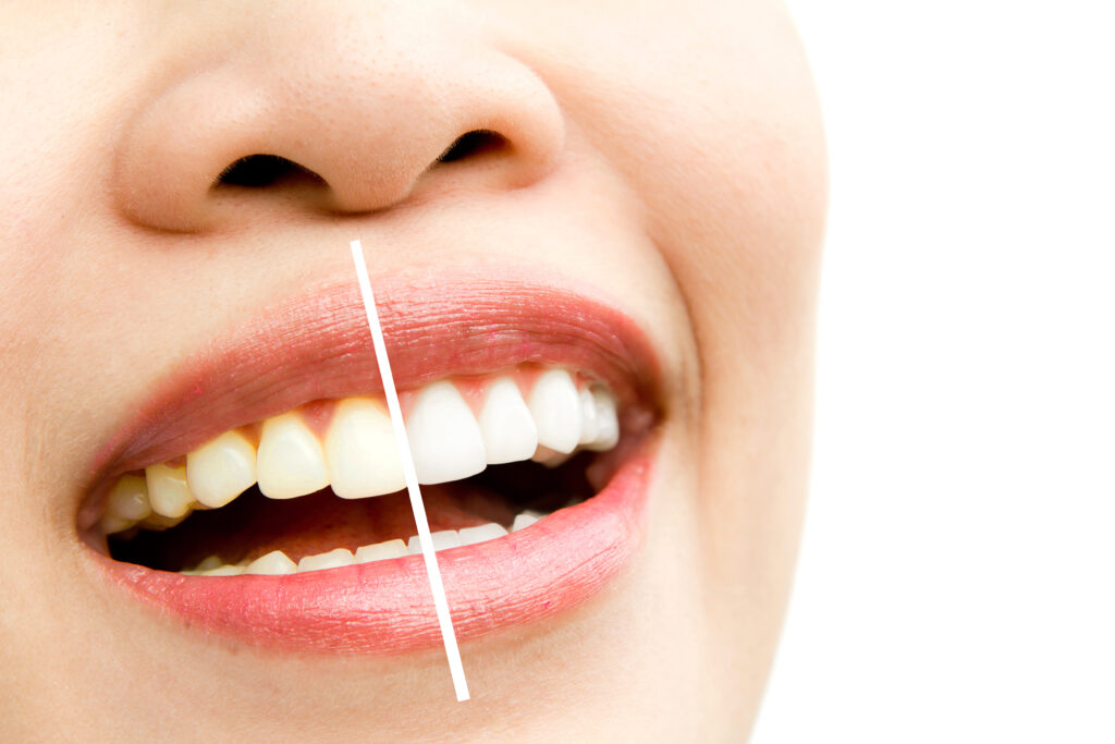 Best Teeth Whitening in Faridabad